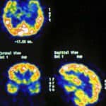 diagnostico-epilepsia-por-pet-150x150