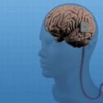 implante-epilepsia