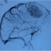 Casos clínicos de patologia craneoencefalica- Tratamiento de un meningioma de convexidad frontal