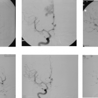 Casos clinicos-patologia vascular-arteriografia-pre-post-malformacion-arteriovenosa-frontal