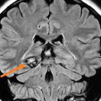 En RM se observa que la lesión tiene aspecto de “mora” con múltiples lóbulos, imagen característica de angioma cavernoso o cavernoma. Se localiza en región hipocámpica.