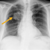 Se realiza estudio preoperatorio apareciendo en la placa de torax una masa a nivel de pulmón derecho que se confirma en el TAC torácico. Se realiza estudio de fibrobroncoscopia y se confirma la existencia de un carcinoma epidermoide pulmonar.