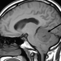Los PNET (tumor neuroectodérmico primitivo ) son tumores de origen embrionario que suelen localizarse en la fosa posterior y preferentemente en la infancia. Son muy agresivos. Las posibilidades de curación estan en relación con una extirpación completa y tratamiento agresivo de radio y quimioterapia.