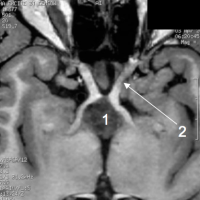 El craneofaringioma es un tumor benigno que se localiza en la región de la silla turca.