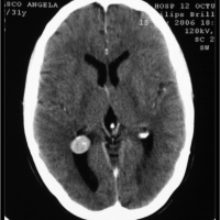 Los meningiomas son tumores benignos. La localización intraventricular es poco frecuente. Si alcanzan grandes tamaños pueden obstruir la circulación del líquido cefalorraquídeo provocando hidrocefalia.