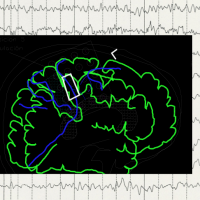 displasia corticla-La intervención quirúrgica se realiza con el paciente despierto y colaborando. Se coloca una manta de electrodos para realizar electrocorticografía, así como estimulación cortical.