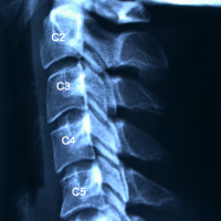 La RX de columna cervical muestra una inversión de lordosis fisiológica. Pinzamiento del espacio c5-c6 .