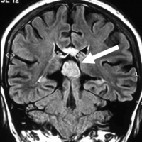 Los tumores de la región pineal, pineocitoma, tienen una incidencia inferior al 1% de todos los tumores intracraneales.