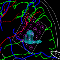 El procedimiento se lleva a cabo utilizando nuestro sistema de integración de imágenes con superposición de arteriografía y resonancia para evitar lesionar arterias corticales.