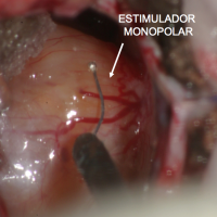 Toda la intervención transcurrió bajo control de monitorización de potenciales evocados somatosensoriales (PESS) de miembros inferiores (MMII), potenciales evocados auditivos de tronco (EAT) y electromiografía (EMG) espontánea y estimulada de los pares craneales del V al XII