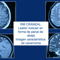 La RM de cráneo muestra una lesión nodular de aspecto vascular de 2 centímetros de diámetro localizada en región rolándica izquierda. Posible cavernoma.