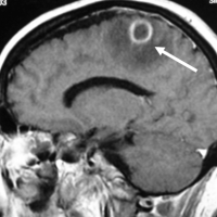 Se realiza una RM craneal, en la que se aprecia una lesión intracerebral a nivel parietal izquierdo nodular, que capta contraste en anillo y que tiene mucho edema perilesional.