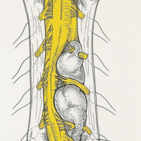 Laminectómía de las vértebras implicadas. Apertura de la duramadre visualizando un tumor que desplaza la médula y depende de raices nerviosas. Resección completa incluyendo componente extraforaminal.