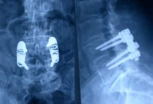 Fig. 19.- Ejemplo de sistema de fijación dinámica. La barra que une los tornillos tiene un mecanismo interno que permite cierta movilidad