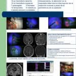 reseccion-radical-de-gliomas-malignos-con-gliolan-monitorizacion-neurofisiologica XVI congreso nacional de neurocirugia Senec- reseccion-radical-de-gliomas-malignos-con-gliolan-monitorizacion-neurofisiologica