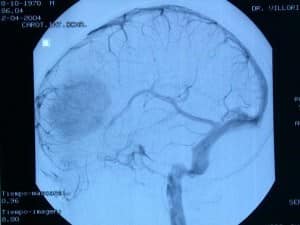 informacion al paciente-patologia craneoncefalica-gliomas-angiografia de una oligodendroglioma frontal