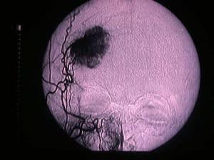 arteriografia-cerebral-vascularizacion-tumor informacion al paciente - patologia craneoencefalica -menigiomas de convexidad -arteriografia