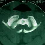 defecto-fusion-arco-posterior-atlas docencia-pregraduados-facultad de medicina uam- defecto-fusion-arco-posterior-atlas