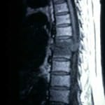 docencia-pregraduados-facultad de medicina uam- discitis-dorsal