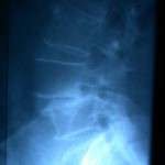 espondilolisis-espondilolistesis-A docencia-pregraduados-facultad de medicina uam- espondilolisis-espondilolistesis-A