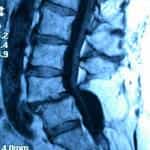 docencia-pregraduados-facultad de medicina uam- espondilolisis-espondilolistesis-B