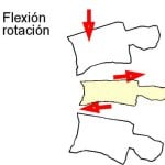 fractura-luxacion-por-flexion-rotacion docencia-pregraduados-facultad de medicina uam- sección medular- fractura-luxacion-por-flexion-rotacion