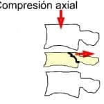 fractura-vertebral-por-compresion-axial docencia-pregraduados-facultad de medicina uam- sección medular- fractura-vertebral-por-compresion-axial