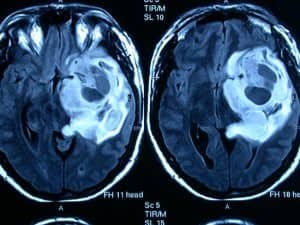informacion al paciente-patologia craneoncefalica-gliomas-de alto grado