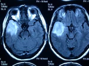 informacion al paciente-patologia craneoncefalica-gliomas-de bajo grado