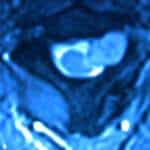 docencia-pregraduados-facultad de medicina uam- rm-axial-cervical-neurinoma-agujero-conjuncion