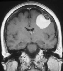 rm-cerebral-mengioma-de-convexidad informacion al paciente - patologia craneoencefalica -rm cerebral maningiomas de convexidad