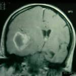 rm-craneal-tumor-produce-desplazamiento docencia-pregraduados-facultad de medicina uam- rm-craneal-tumor-produce-desplazamiento