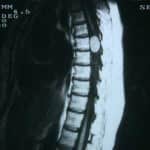 docencia-pregraduados-facultad de medicina uam- rm-dorsal-meningioma