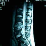 docencia-pregraduados-facultad de medicina uam- rm-lumbar-metastasis-vertebral