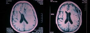 rm-pre-postoperatoria-meningioma-de-convexidad informacion al paciente - patologia craneoencefalica -meningiomas de convexidad-RM pre y postoperatoria