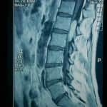 docencia-pregraduados-facultad de medicina uam- rm-sagital-lumbar-neurinoma