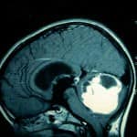 rm-sagital-tumor-desplaza-amigdalas-cerebelosas docencia-pregraduados-facultad de medicina uam- rm-sagital-tumor-desplaza-amigdalas-cerebelosas