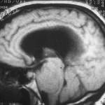 docencia-pregraduados-facultad de medicina uam- rm-sagital-tumor-produce-hidrocefalia