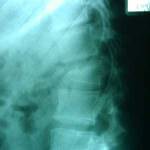 rx-lateral-fractura-acunamiento-d1 docencia-pregraduados-facultad de medicina uam- sección medular- rx-lateral-fractura-acunamiento-d1