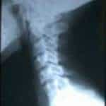 sindrome-klippel-feil docencia-pregraduados-facultad de medicina uam- sindrome-klippel-feil