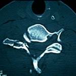 tac-cervical-cuerpo-apofisis-articular docencia-pregraduados-facultad de medicina uam- sección medular- tac-cervical-cuerpo-apofisis-articular