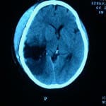 informacion al paciente-patologia craneoncefalica-gliomas-tac de control