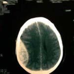 docencia-pregraduados-facultad de medicina uam- tac-craneal-hematoma-epidural-parietotemporal