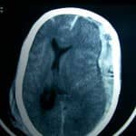 docencia-pregraduados-facultad de medicina uam- tac-craneal-hematoma-subdural-agudo