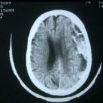 tac-craneal-hematoma-subdural-agudo docencia-pregraduados-facultad de medicina uam- tac-craneal-hematoma-subdural-agudo