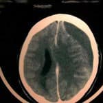 tac-craneal-hematoma-subdural-isodenso docencia-pregraduados-facultad de medicina uam- tac-craneal-hematoma-subdural-isodenso