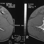 tac-lumbar-fractura-estallido docencia-pregraduados-facultad de medicina uam- sección medular-tac-lumbar-fractura-estallido