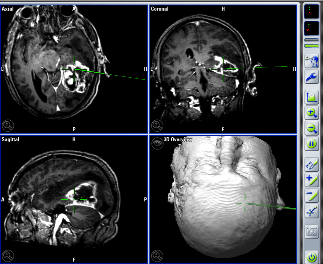 información al paciente-patologia craneoencefalica-meningioma de la hoz cerebral-glioblastoma-neuronavegador