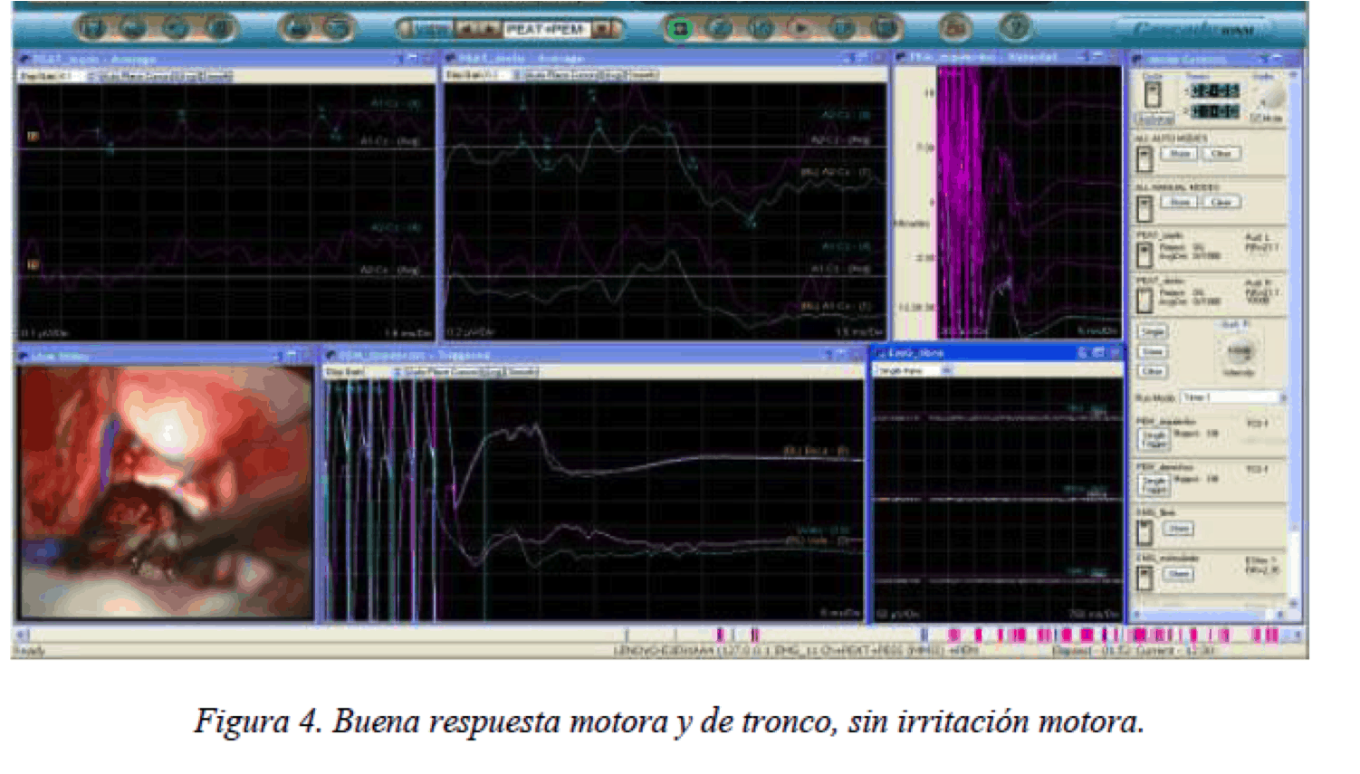 Casos clinicos de patologia craneoencefalica-neurinoma del acustico