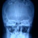 Seccion Investigacion-Cirugia de la Epilepsia-radiografia-estimulacion-subtalamica-epilepsia
